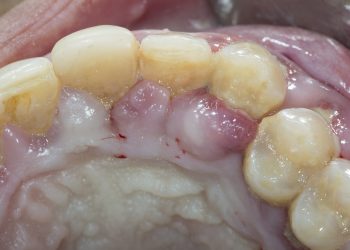 Early Signs of Periodontal Disease: How to Identify and Prevent Disease Progression