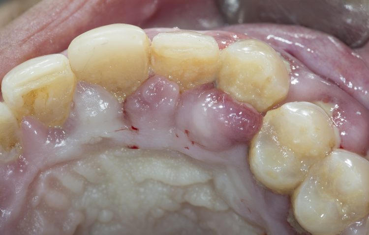 Early Signs of Periodontal Disease: How to Identify and Prevent Disease Progression