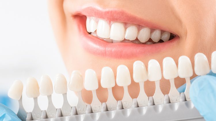 The Art and Science of Teeth Whitening: A Comprehensive Guide