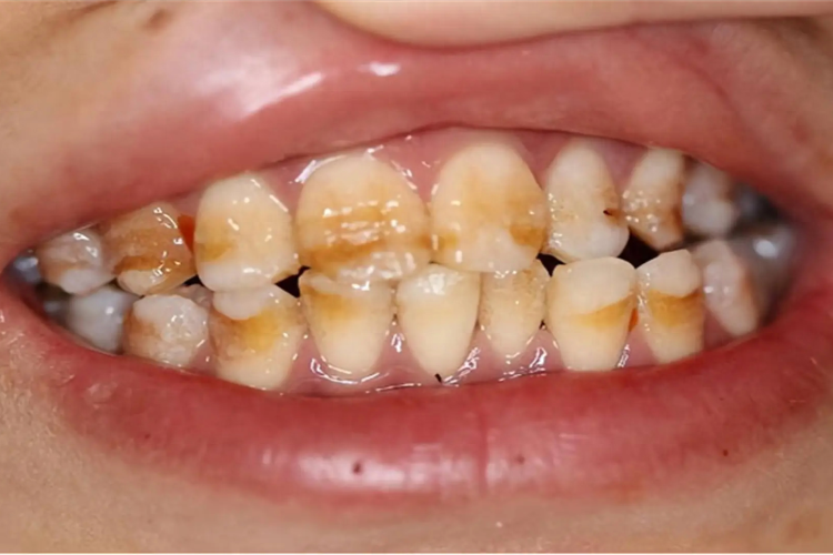 The truth about tooth discoloration: a dual approach of internal and external factors