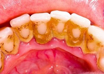 Mechanism of tartar formation and its removal methods: key steps in maintaining periodontal health