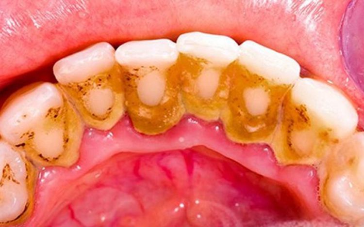 Mechanism of tartar formation and its removal methods: key steps in maintaining periodontal health