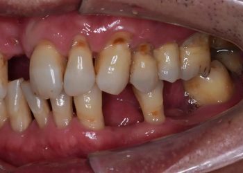 The impact and solution of tooth loss: reconstructing a perfect smile