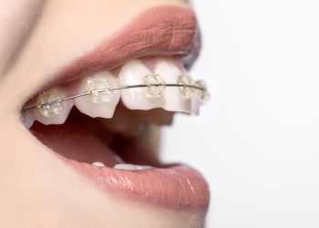 The necessity of orthodontic treatment: improving bite function and aesthetics