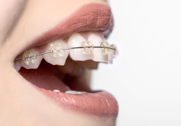 The necessity of orthodontic treatment: improving bite function and aesthetics