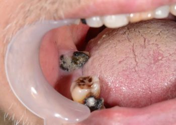 Early detection and prevention of oral cancer: Be alert to potential life threats