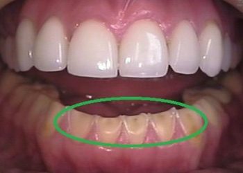 Prevention and treatment of dental erosion: resisting the invasion of acidic foods