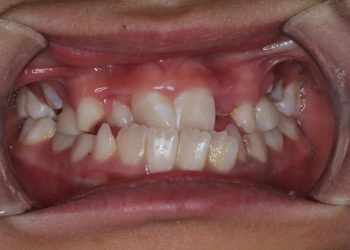 Clinical manifestations and intervention measures of abnormal tooth development: focusing on children’s growth