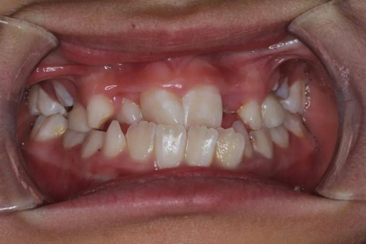 Clinical manifestations and intervention measures of abnormal tooth development: focusing on children’s growth