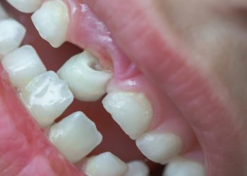 Emergency measures and followup treatment plan for tooth perforation: rapid response to reduce damage