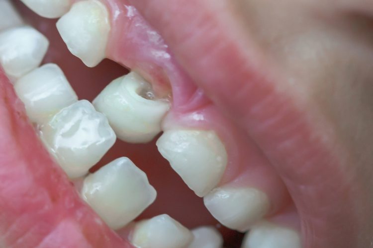 Emergency measures and followup treatment plan for tooth perforation: rapid response to reduce damage