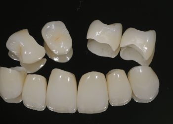Embracing Elegance: The Transition from Porcelain-Fused-to-Metal Crowns to All-Ceramic Solutions