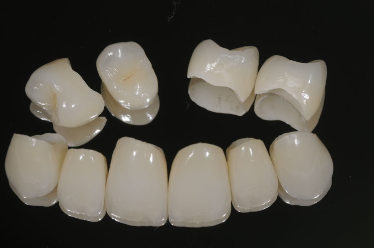 Embracing Elegance: The Transition from Porcelain-Fused-to-Metal Crowns to All-Ceramic Solutions