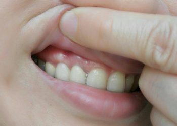 Root cause analysis of tooth sensitivity: daily care tips