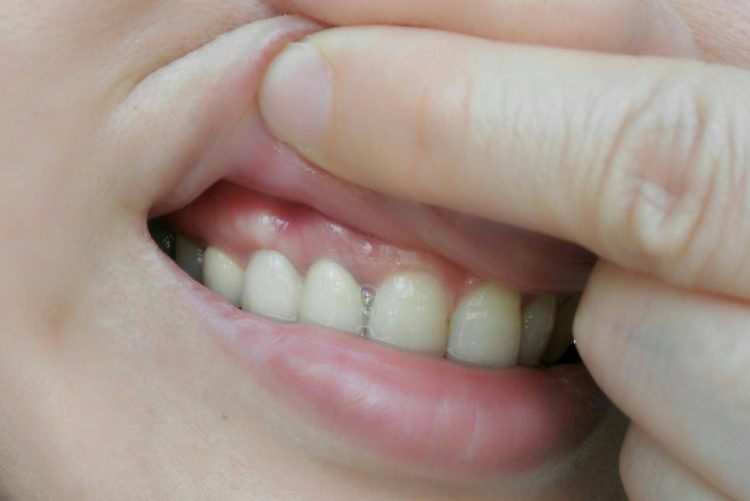 Root cause analysis of tooth sensitivity: daily care tips