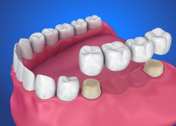 The Material Secrets Behind All-Ceramic Crowns: Enhancing Longevity and Aesthetics