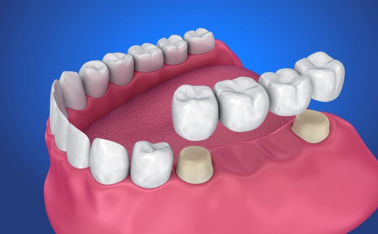 The Material Secrets Behind All-Ceramic Crowns: Enhancing Longevity and Aesthetics