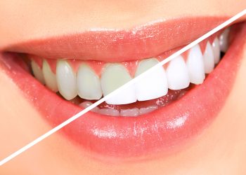 Natural Secrets to Achieve Radiant White Teeth