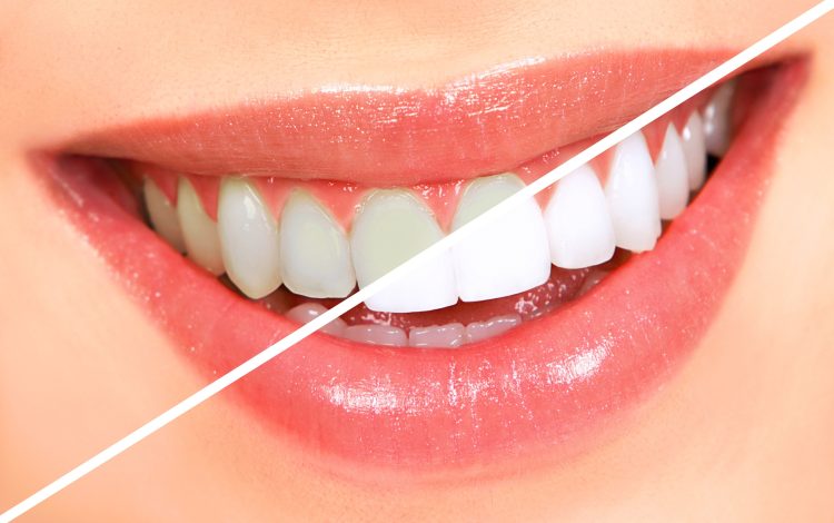 Natural Secrets to Achieve Radiant White Teeth