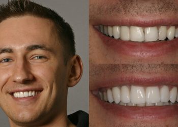 The Distinction Between U.S.-Canada Veneers and Emax Veneers: An In-Depth Analysis