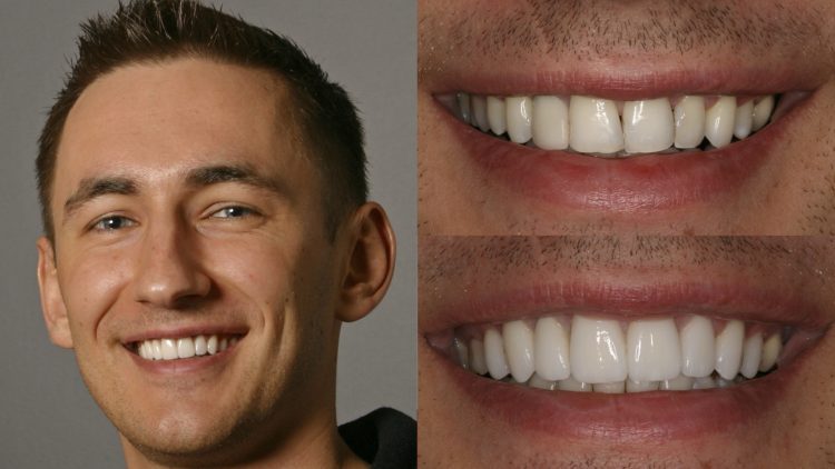 The Distinction Between U.S.-Canada Veneers and Emax Veneers: An In-Depth Analysis