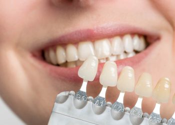 Radiant Smiles: A Comprehensive Guide to Dental Veneers