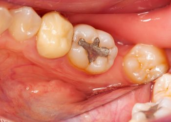 Causes and prevention strategies of dental caries: protecting teeth from corrosion