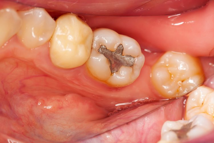 Causes and prevention strategies of dental caries: protecting teeth from corrosion