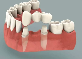 Key Considerations for Using Adhesive Bridges