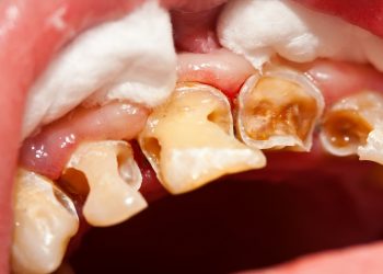 The truth about dental caries: understanding its causes, symptoms, and effective treatment plans