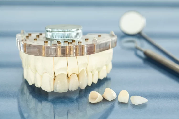 Choosing Between Porcelain-Fused-to-Metal and All-Ceramic Crowns: A Comprehensive Guide