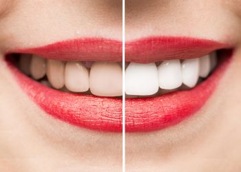 The Quest for Radiance: Understanding and Restoring Tooth Color