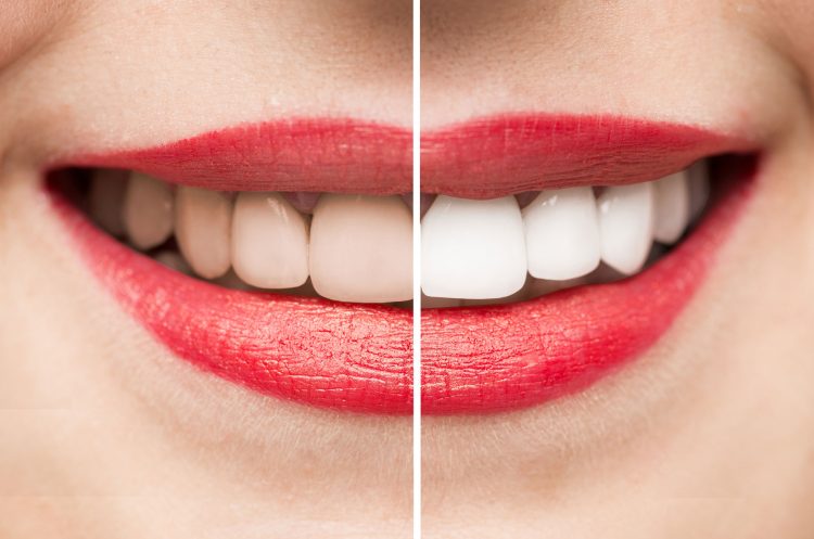 The Quest for Radiance: Understanding and Restoring Tooth Color
