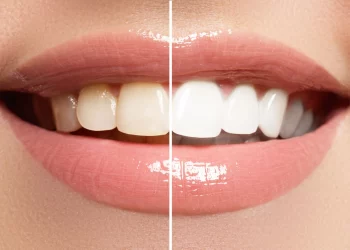 The Art of Whitening Fluorosis-Stained Teeth: Achieving A Radiant Smile