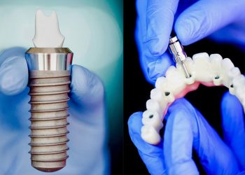 Dental Implants: A Comprehensive Guide to Techniques, Procedures, Considerations, and Aftercare