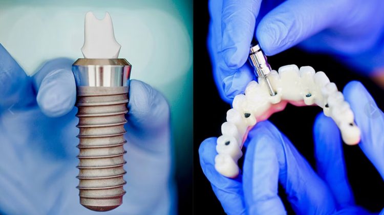 Dental Implants: A Comprehensive Guide to Techniques, Procedures, Considerations, and Aftercare