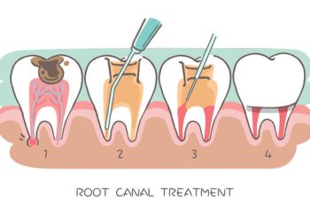 Root Canal Treatment: Comprehensive Analysis and Practice