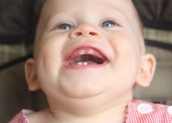 Do Milk Teeth Need to Be Treated for Cavities?