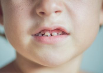 How to Prevent Cavities in Children’s Milk Teeth: Daily Preventive Measures