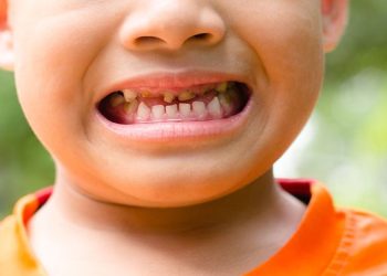 How to Prevent Tooth Decay in Daily Life