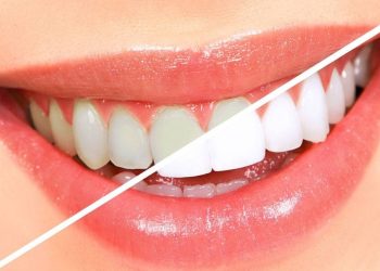 Laser teeth whitening: The perfect combination of science, safety and beauty
