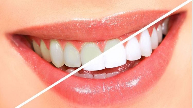 Laser teeth whitening: The perfect combination of science, safety and beauty