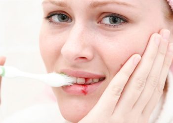 How to Prevent Gum Bleeding: A Comprehensive Prevention Guide