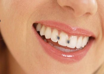 Effective Treatment Methods for Severe Tooth Decay