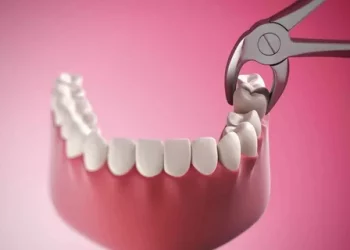 Wisdom Tooth Extraction: A Comprehensive Guide to Indications, Procedure, Aftercare, and Complications