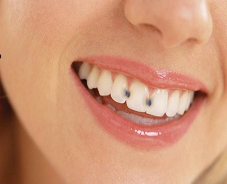 Effective Treatment Methods for Severe Tooth Decay