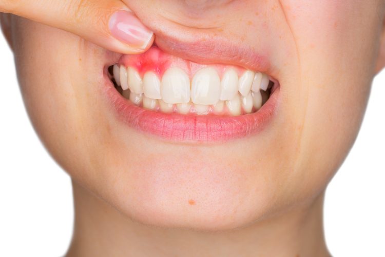 How to Prevent Periodontitis