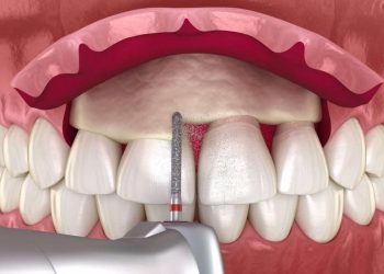 An Evaluation of Bone Grafting Techniques for Early Loading in Dental Implants: Long vs. Short Implants