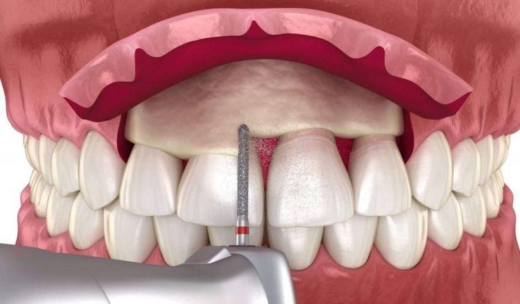 An Evaluation of Bone Grafting Techniques for Early Loading in Dental Implants: Long vs. Short Implants