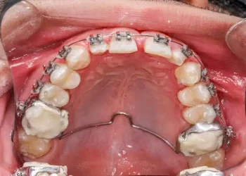 The Art of Expanding Smiles: Understanding the Palate Expander